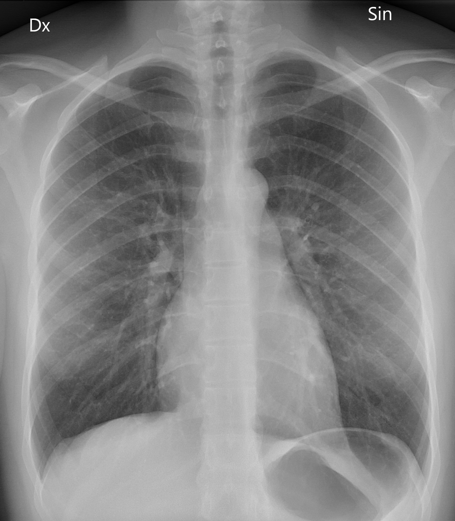 Real PA chest radiograph of another person (Mikael Häggström, CC0), with its own markers Dx (right) and Sin (left)